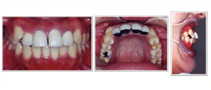 補綴（人工歯）による無理な歯並びの治療
