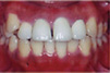 補綴（人工歯）による無理な歯並びの治療