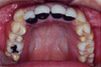 補綴（人工歯）による無理な歯並びの治療