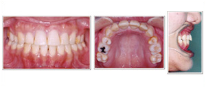 補綴（人工歯）による無理な歯並びの治療