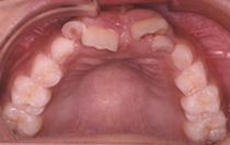 噛み合わせに問題がある症例