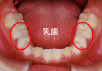 噛み合わせに問題がある症例