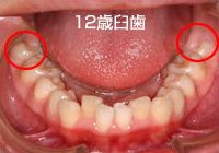 2期治療