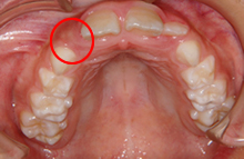 永久歯の生えるスペースがない・はみ出して並んでいる