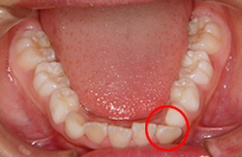 永久歯の生えるスペースがない・はみ出して並んでいる