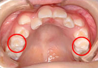 前歯のデコボコと八重歯