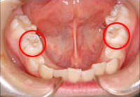 前歯のデコボコと八重歯