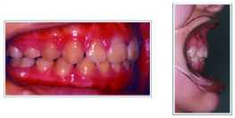 上顎前突治療後