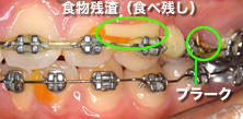 食べかす（食物残渣）やプラークが残っている状態